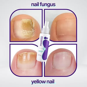 Nail Fungus Spray – Toenail & Foot Fungus Treatment